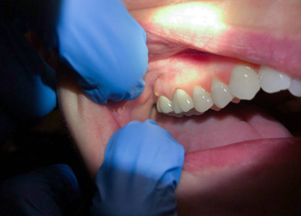 Best Emergency Dentist for Lost Fillings or Crowns in Randolph Af, TX
